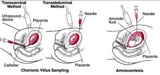 Your medical examination report for commercial driver fitness determination will be send electronically to the commercial driver's license information system. Chorionic Villus Sampling What Is Definition Risks Procedure Contraindications Results Cvs Is A Diagnostic Pren Procedure Definitions Genetic Testing