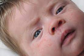 Do you need baby detergent? 5 Common Types Of Skin Allergies In Babies And Treatment