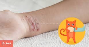 Cat bite treatment is necessary to prevent serious illness and disease. Cat Scratch Fever See Your Doctor Find Natural Relief Dr Axe