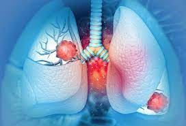 Covid is masking the symptoms of deadliest cancer in uk. Lung Cancer Risk Factors Causes Symptoms Treatment