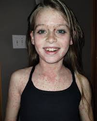 Her girl has had skin issues, and I am willing to try this. So far she  enjoys it, we also use green light therapy. She has lost a significant  amount of hair.