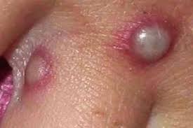 Monkeypox is an infectious disease caused by the monkeypox virus that can occur in certain animals including humans. What Is Monkeypox Viral Zoonotic Disease Found In Uk Wales Online