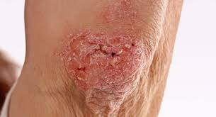 A tight cloth may not allow air circulation on your skin and it can encourage skin irritation and clogging of skin pores to trap sweats that lead to skin sometimes your buttocks may develop bumps that are not pimples. Butt Rashes Causes Home Remedies Treatment And More