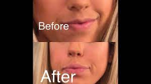 Pmd Lip Plumping System Review Youtube