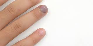 What To Do When Your Fingernail Gets Bruised Or Falls Off Cure Nails Nail Remedies Natural Nail Care
