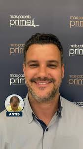 Um resultado de #maiscabello e mais autoestima!, O transplante capilar da  Mais Cabello conta com um acompanhamento completo de 1 ano para garantir um  resultado final com crescimento saudável e ...