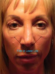 How long should i wait after my last botox? Dissolving Fillers Under The Eyes Adam Scheiner Md