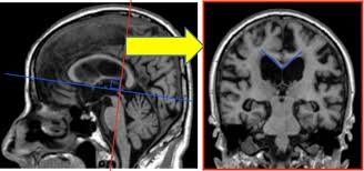 By this point, most caregivers are worried that something is seriously wrong and seek medical attention. Diagnostic Imaging Of Dementia With Lewy Bodies Frontotemporal Lobar Degeneration And Normal Pressure Hydrocephalus Springerlink
