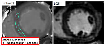 Journal of the american college of cardiology vol. Cmr Indications