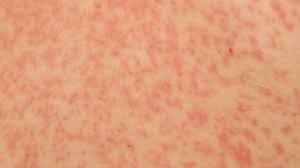 Es verursacht bei den meisten infizierten keinerlei beschwerden. West Nile Virus Symptoms Causes And Treatment