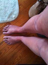 Coagulation disorders are disruptions in the body's ability to control blood clotting. 17 Riley Day Syndrome Ideas Dysautonomia Syndrome Riley