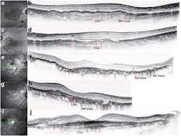 What does bm stand for in break? Bm Undulation In Eyes With Cnv Secondary To Angioid Streaks As And Amd Download Scientific Diagram