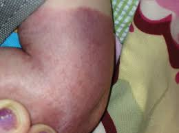 How long do you leave a tourniquet on? Distal Petechiae After Tourniquet Use Consultant360