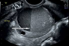 What are the symptoms of stage 1 ovarian cancer? Sonographic Assessment Of Ovarian Cysts And Masses Chapter 8 Gynaecological Ultrasound Scanning