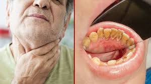 A canker sore looks like an ulcer, usually with a depression in the center. Cancer On Cheek Inside Mouth Shefalitayal