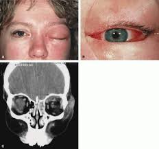 Image result for Proptosis