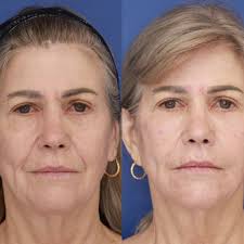 TOP 10 BEST Filler in Tukwila, WA