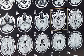 New vaccine guidance for people living with ms plus the latest information and resources. Multiple Sklerose Krankheitsverlauf Ist Vom Klima Abhangig Stern De