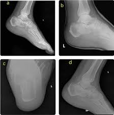 Image result for Calcaneus Compression Fracture