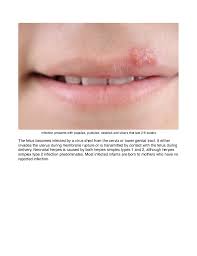 Herpes Virus Infection In Pregnancy