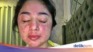 Ruam Gejala COVID-19 Vs Ruam Biasa, Bedanya Apa Sih? Ini Kata Dokter Kulit