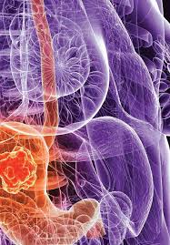 Mcc most often starts on skin that's exposed to the sun, like the face, neck, and arms. Variants Of Gastric Carcinoma Morphologic And Theranostic Importance Intechopen