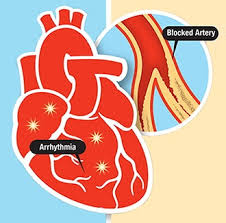Coronary heart disease, heart attack, cardiomyopathy, valve problems and abnormal dr goel advises the patient to calm down and take a couple of aspirins or disprins and go to a hospital immediately. source: Cardiac Arrest Vs Heart Attack