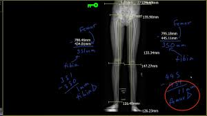 Image result for Functional Leg Length Discrepancy