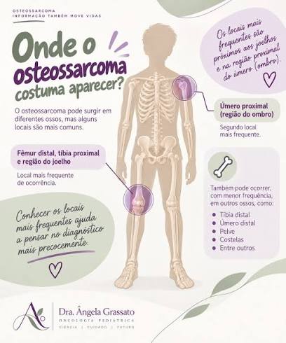 🦴 Você sabia que o osteossarcoma é o câncer ósseo mais comum na infância e  adolescência? Apesar de ser conhecido como o tumor que “produz osso”, ele  nem sempre é fácil de