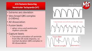 Your episodes of fast heart rate are occurring more often or do not return to normal on their own. Vt Ventricular Tachycardia Vs Svt Supraventricular Tachycardia With Aberrancy Youtube