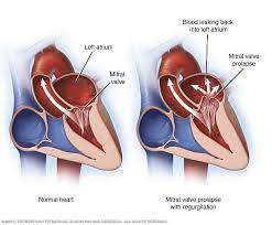 Symptoms And Causes Mitral Valve Regurgitation Mitral Valve Prolapse Mitral Valve Regurgitation Mitral Valve