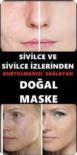 En Iyi Sivilce Maskesi Ve Sivilce Giderici Maske Tarifi Sivilce Izi Cilt Tedavileri Cilt Bakimi