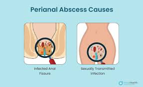 Image result for Perianal Abscess