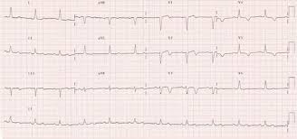 Electrocardiographic Changes After Angioplasty Of The Left Anterior Descending Coronary Artery Circulation