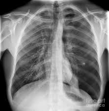 Now with integrated gestational age calculator and decision support (e.g., retinopathy of prematurity, rsv prophylaxis). Pneumothorax X Ray Photograph By Science Photo Library