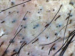Hair loss is a rampant problem that men of all ages face. Alopecia Areata An Update Seetharam Ka Indian J Dermatol Venereol Leprol