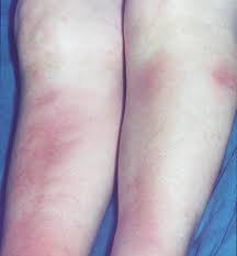 Image result for erythema nodosum