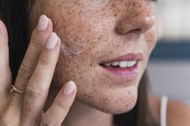 Image result for Freckled skin