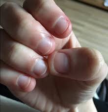 Damage to the cuticle and skin of the fingers can lead to bacterial and viral infections of the hands. Here S Why You Should Stop Biting Off The Skin Around Your Fingernails This Is Alarming