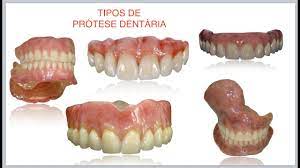 Tipos De Protese Dentaria Fixas E Removiveis Youtube