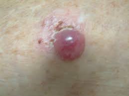 Merkel cell carcinoma (mcc) is a rare skin cancer that often looks harmless. Merkel Cell Carcinoma Treatment With Bleomycin