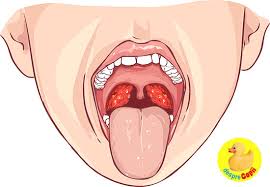 Durerea in gat poate implica si un tratament pentru streptococ in gat. Amigdalita Tonsilita La Copil Cauze Si Tratament Desprecopii Com