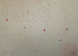 How To Treat Dots Bumps And Red Spots On Skin Skin Spots Dots Red Dots