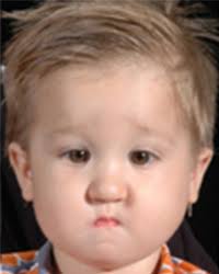 Pierre Robin Sequence Before & After Pictures Dallas, Plano, TX