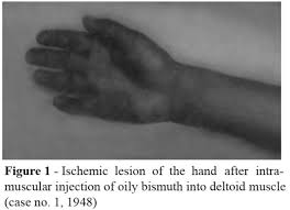 • gary went to university but dropped out after a year. Intramuscular Accident With Drug Injection In The Deltoid Muscle Local And Distant Lesions Review Of 32 Cases