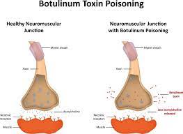 Botulisme wordt veroorzaakt door toxinen (= gifstoffen) die worden geproduceerd door de bacterie clostridium botulinum. Botulisme Patofisiologi Diagnosis Penatalaksanaan Alomedika