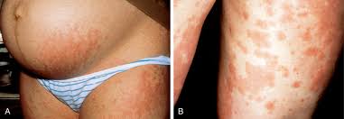 Image result for pruritic urticarial papules and plaques of pregnancy