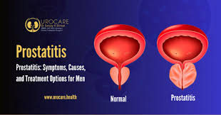 Image result for Chronic Bacterial Prostatitis