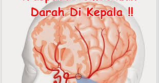 Sakit kepala yang berkepanjangan merupakan gejala gumpalan darah di kepala yang sering diabaikan. Putri Distributor Resmi Obat Herbal Obat Penghancur Darah Beku Di Kepala Terampuh