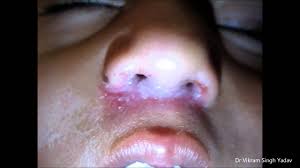  persistent infected discharge from nose leading to irritation and maceration of skin of the vestibule like rhinitis sinusitis or nasal allergy. Acute Vestibulitis Management Youtube
